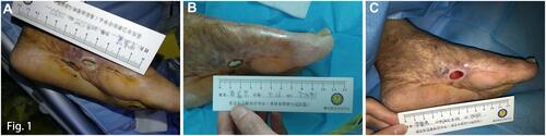 Figure 1 Wound status after debridement, vancomycin-loaded bone cement implant, and negative pressure wound therapy installment. (A) After sharp debridement; (B) After resection of non-viable bone and application of the vancomycin-loaded bone cement implant; (C) After negative pressure wound therapy installment.