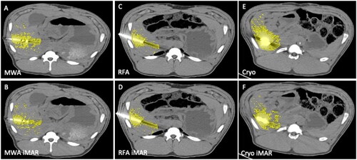 Figure 3. Metal artifact shown in yellow in different ablation probes MWA (A,B), RFA (C,D) and CRYO (E,F) without iMAR (upper row) and with iMAR (bottom row).