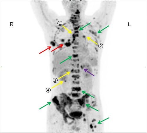 Figure 4 PET/CT result indicated multiple systemic metastases, including bone (green arrows), lung (red arrows), left adrenal glands (purple arrow), multiple lymph node metastases in the mediastinum (yellow arrow 1), hilar (yellow arrow 2), abdominal aorta (yellow arrow 3) and right posterior renal space (yellow arrow 4).