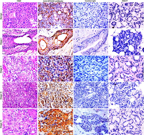 Figure 3. Validation of SPAG9 protein expression in various stages of SGT by immunohistochemistry. First panel shows representative images for H&E staining in benign, malignant stage I, II, III, and IV tumor specimens. Second panel shows the representative images for the cytoplasmic localization of SPAG9 protein probed with anti-SPAG9 antibody as depicted by brown color immunoreactivity. No immunoreactivity was observed in serial tumor sections probed with control IgG, as shown in the third panel. Fourth panel depicts no immunoreactivity against SPAG9 protein in ANCT specimens when probed with anti-SPAG9 antibody. Original magnification: x400; objective: x40.