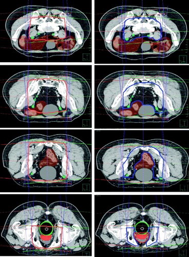 Figure 1.  Conformal avoidance based target definition. Column on the left shows creation of the 4-field box at different levels in the pelvis (in red). Column on the right shows modifications and subtraction of normal volumes to create the nodal PTV (blue). Bowel is shown in brown, bladder in gray, prostate in red, and rectum in green.