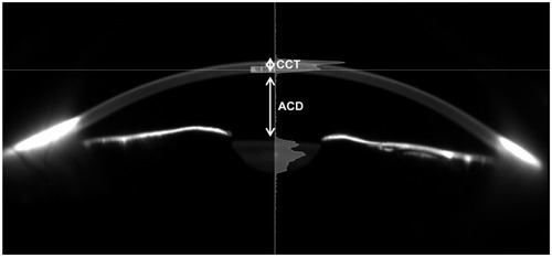 Figure 1 Image of anterior segment obtained with the Sirius® Scheimpflug device.