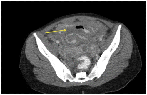 Figure 6e: Axial post-contrast CT abdomen showing markedly thickened small bowel loops (arrow) in a known patient with lymphoma