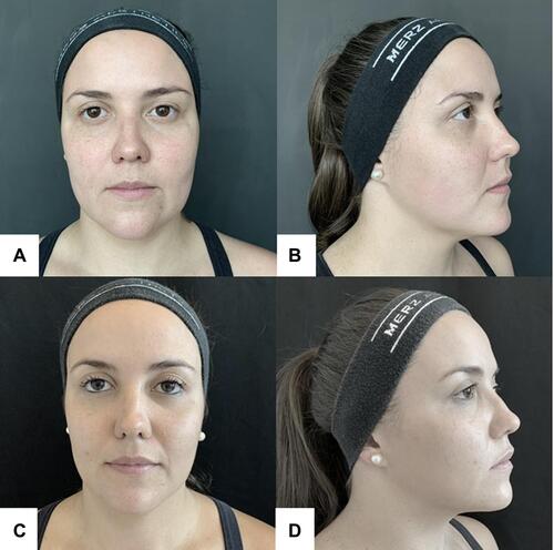 Figure 3 Woman, 33 years old; (A and B) Before procedure; (C and D) 180 days after procedure: slimming of the middle third of the face and improvement of the jawline.