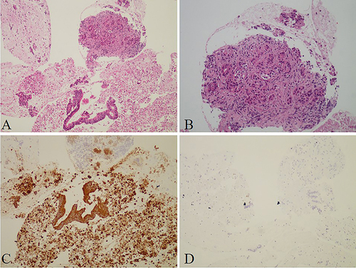 Figure 4 (A) Low power and (B) higher power image of hematoxylin and eosin stains of the pancreatic mass showed atypical glands with a cribriform pattern. (C) Cytokeratin 7 expression within the glandular component was positive. (D) Cytokeratin 20 expression was negative within the glands.