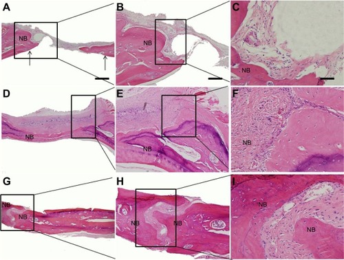 Figure 10 Hematoxylin and eosin staining.Notes: (A, B, C) control group; the arrows in (A) show the defect edge; (D, E, F) paper-stacking membranes group; (G, H, I) adipose-derived stem cell (ADSC)-laden paper-stacking membranes group; and NB is new bone. The scale bar of (A), (D), and (G) is 500 μm. The scale bar of (B), (E), and (H) is 200 μm. The scale bar of (C), (F), and (I) is 50 μm.