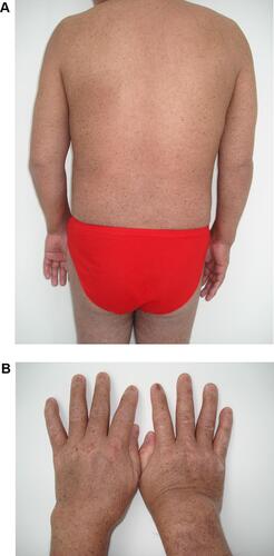 Figure 3 Complete resolution of the lesions leaving hyperpigmented spots throughout the body after 6 months (A). Complete regression of skin, nail lesions, and the swelling joint (B).