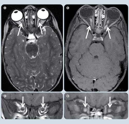 Figure 9. Bilateral optic nerve glioma.(A) Axial T2-weighted, (B) axial T1-weighted fat-suppressed postgadolinium, (C) coronal T1-weighted, and coronal T1-weighted fat-supressed postgadolinium (D) MRI at level of optic nerves. Symmetrical enlargement of both optic nerves with homogeneous contrast enhancement is seen (white arrows). The optic chiasm (black arrowhead) and the rest of the optic pathways are spared.