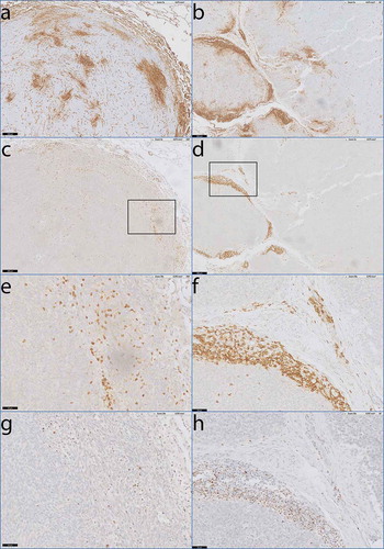 Figure 5. Co-localisation of activated T-cells and HLA-I expression in monophasic and biphasic SS.Digitally overlaid slides of consecutive sections that were stained with antibodies specific for HLA-I, CD3, and T-bet. a) Heterogeneous staining of HLA-A in monophasic SS07. b) Heterogeneous staining of HLA-B/C in biphasic SS45. c-d) consecutive slide after a and b demonstrating dense T-cell infiltration by anti-CD3 staining in areas of elevated HLA-I expression. e-f) Magnification of c and d. g) consecutive slide after e, demonstrating T-bet positivity of densely infiltrated T-cells. h) consecutive slide after f demonstrating T-bet positivity of densely infiltrated T-cells as well.Scale bars: a-d: 200 µm, e-h: 50 µm.