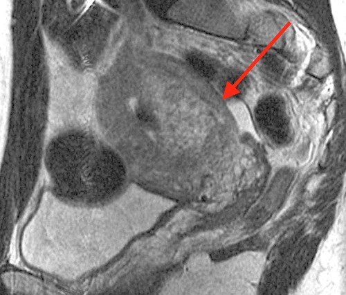 Figure 2 Magnetic resonance image showing a portion of retained placenta 6 weeks postpartum. The arrow indicates an area where the light-gray placenta is deeply invasive into the darker-gray myometrium. Placenta accreta spectrum was confirmed pathologically following hysterectomy.