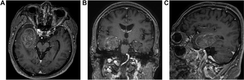 Figure 2 Brain magnetic resonance images showing a 36×31 mm metastatic mass in the right perihippocampal area.