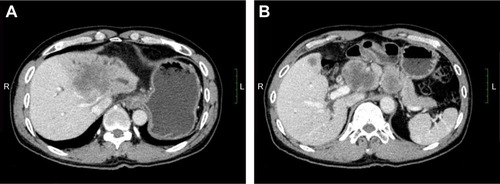 Figure 1 Abdominal CT images show that one of the lesions was located in the left lobe of the liver and the other was located in the para-aortic lymph node (A and B). In the venous phase, the mass was of low density and was irregular.