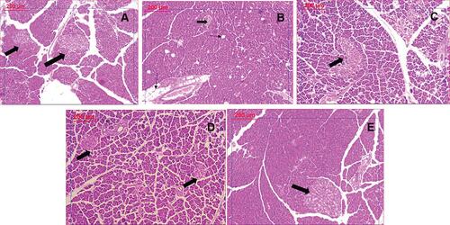 Figure 9 Histological examination of pancreatic tissues stained by H&E: (A) Control group showing normal islets. (B) PCOS group revealing significant decrease in islet mass (thick arrow) and increased vacuolation (thin arrow). (C) Clomiphene treatment showing improved islets and less vacuoles. (D and E): Nanocurcumin treated groups NC-100 and NC-200 respectively showing restored islet mass and absence of vacuoles.