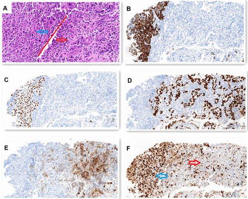 Figure 2 (A) H-E staining shows that SCC (blue arrow) presents a solid sheet-like arrangement. The cell cytoplasm is red stained, the nucleus is large, nucleoli and mitosis, no intracellular keratinizing and keratinizing beads are seen, but AC (red arrow) is adenoid, cord-like or solid arrangement. The cell cytoplasm is reddish or translucent, the nucleus is large and irregular, and nucleoli and mitosis can be seen. (x200). SCC accounts for about 10% and AC accounts for about 90% of the tumor. IHC staining shows: (B) CK5/6 and (C) P40 are positive in SCC components. (x200) (D) TTF-1 and (E) Napsin-A are positive in AC components. (x200) (F) Ki-67 index is about 70% in SCC (blue arrow) and about 30% in AC (red arrow). (x200).