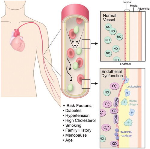 Figure 1 Mechanisms underlying endothelial dysfunction and the functional consequences of decreased vascular bioavailability of nitric oxide(NO). In the presence of cardiovascular risk factors such as hypertension, diabetes mellitus, smoking, age, menopause, familiar history of cardiovascular disease and hypercholesterolemia, vascular superoxide‐producing enzymes such as the vascular NADPH oxidase, the xanthine oxidase (XO), and an uncoupled endothelial nitric oxide synthase (eNOS) produce large amounts of superoxide (O2·−), which will metabolize NO. The consequences are adhesion and infiltration of the vascular wall with inflammatory cells such as macrophages and neutrophils and a subsequent intima proliferation.