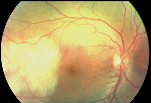 Figure 1 Case 1. Fundus photograph. Massive yellowish lesion, temporal to fovea, with an exudative detachment involving the fovea and choroidal folds.