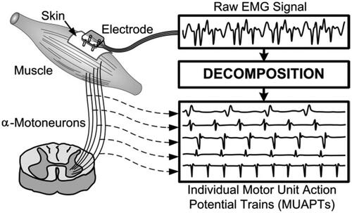 Figure 3. EMG signal and decomposition of MUAPs.