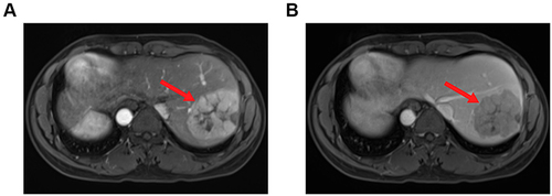 Figure 3 Magnetic resonance imaging showing a mass (red arrow) measuring 7.6 × 5.8 × 6.5 cm in segment VII and VIII of liver, (A) T1-weighted image; (B) T2-weighted image.