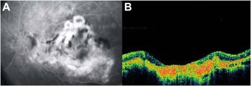 Figure 19 Disciform scar in age-related macular degeneration.