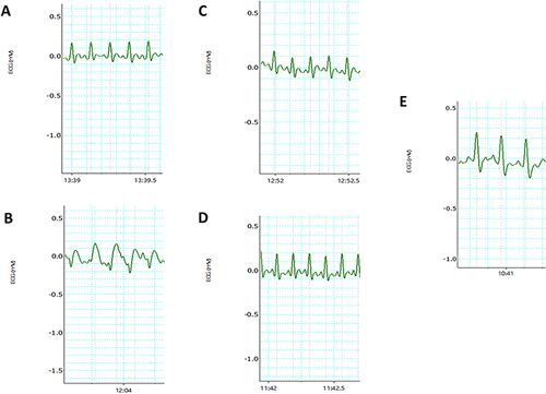 Figure 2 Typical electrocardiogram tracings obtained at the end of the experimental period of the (A) NC group, (B) DC group, (C) LD group, (D) HD group and (E) MET group. Dotted lines indicate where measurements were taken by the LabChart™ software.