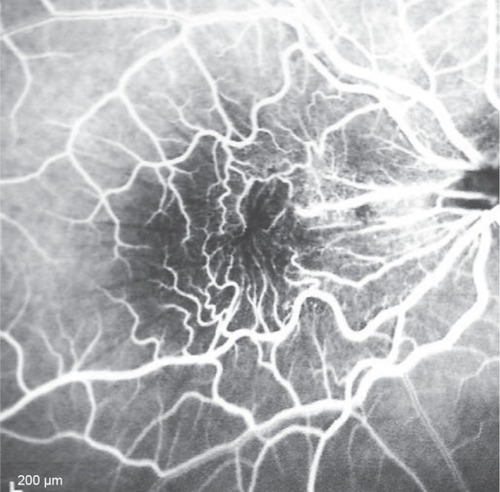 Figure 4 Arteriovenous phase of fluorescein angiography transit.