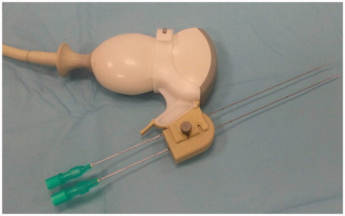 Figure 3. Convex US probe with lateral-mounted laser needle guide: two needles spaced 12 mm apart are inserted.