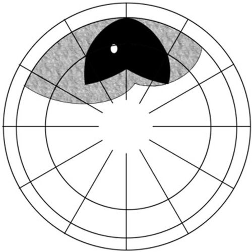 Figure 4 Group 3(A): detachments intersecting 12 o’clock.