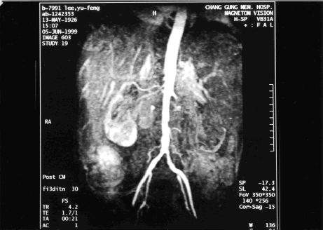 Figure 2. Magnetic resonance imaging and magnetic resonance angiography showed infarction in bilateral kidneys. The involvement of left renal artery was more severe with complete obliteration of left renal artery. Partial occlusion of right renal artery with preserved upper polar artery and capsular eatery was also found.