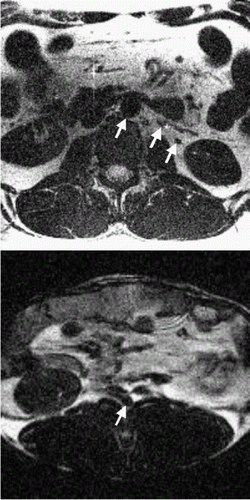 Figure 1. Flow suppressed MPSSFP applied to a 5 mm slice through the abdomen of a healthy volunteer (a) and a rabbit (b). Arrows point to the aorta in both images and the renal vessels the volunteer image.