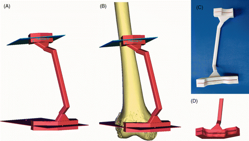 Figure 2. The 3D femur and planes of resection were exported as STL files that were then transferred to the rapid prototyping software. (A) A patient-specific CAD/CAM surgical jig was designed with cutting slits based on the exact orientation of the resection planes defined in the virtual planning. (B) The two cutting blocks were connected by a handle with an orientation that could facilitate positioning without obstructing the surgical exposure. (C) The undersurface of the surgical jig. (D) The cutting blocks had anatomical shapes that matched the bone surface at the defined resection level. This ensured easy and accurate positioning of the jig during the surgery.