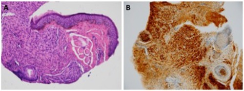 Figure 2 The histopathologic and histochemical studies of the solitary neurofibroma.