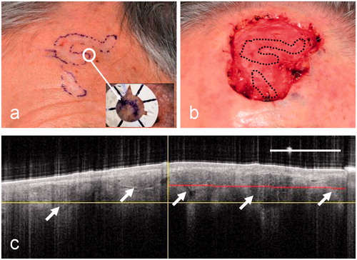 Figure 7. Clinical images of patient 5 before (a) and after (b) surgery for a micronodular BCC. This case shows a particularly large surgical defect relative to the clinical border (black dotted lines). (c) A clinician-selected OCT image straddling the pre-surgical border. In this case the OCT image shows irregularly sized ovoid regions with bright borders (arrowed) and large dark regions (arrowed). These extend throughout the image and well beyond the clinical border (vertical line).