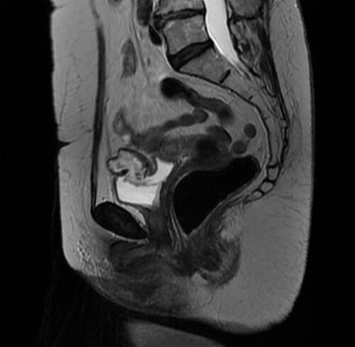 Figure 3 MRI scan showing the connection of the calcified cystic lesion with the bladder lumen.
