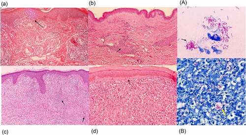 Figure 4. Histopathology of leprosy. (a) TT is characterized by granulomas with lymphocyte infiltration. These are multiple, well-formed granulomas with multinuclear Langhans giant cells. Erosion of the basal layer of epidermis is observed, with lymphocytes (→). (HE stain, 40×). (b) in BT lesions a granulomatous appearance can be observed (→), similar to TT lesions, with the presence of a grenz zone. Lymphocytic infiltration is less than in TT. (HE stain, 40×). (c) in BL cases, lymphocytic infiltration and histiocytes (→) with granular to foamy cytoplasm are observed. (HE stain, 40×). (d) LL is characterized by foamy histiocytes with a grenz zone below the epidermis. (→) (HE stain, 40×) (A) the slit skin smear test shows the acid fast bacilli. (→) (Ziehl- Neelsen stain, 1000×). (B) a large number of bacilli are observed within foamy histiocytes with LL lesions. (→) (Ziehl- Neelsen stain, Wade-Fite, 400×). Photomicrographs are courtesy of Dr. Norihisa Ishii, National Sanatorium Tama Zenshoen.