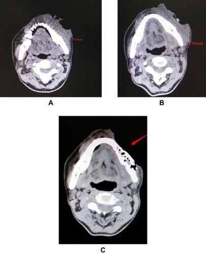 Figure 1 Head and neck CT images showing tumor before (A) and after treatment with nivolumab (B, C, respectively).