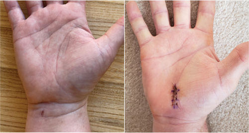 Figure 2. Representative wound healing images in heavy manual laborers 1 week after CTR-US using a wrist incision (left) and mOCTR using a palmar incision (right).