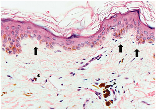 Figure 2. A punch biopsy of the right upper arm shows a subtle vacuolar interface with vacuolar changes and necrotic keratinocytes (black arrows). Perivascular inflammation is present and dermal melanophages (asterisks) are seen (Hematoxylin and Eosin, 400x).