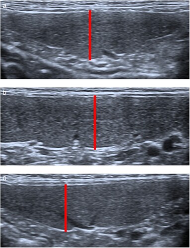 Figure 1. Ultrasound images demonstrating position of cursors (connected by solid line) for measurement of splenic thickness. For the head (a) and tail (c) of the spleen, which were imaged in a transverse plane, measurement cursors were placed on the near edge of the parietal capsule margin and the far edge of the visceral capsule margin, adjacent to the indentation from the splenic vein radicle. For the body of the spleen (b), which was imaged in a sagittal plane, the measurement was similarly made from a clearly defined splenic radicle to the opposite surface perpendicular to the long axis of the spleen.