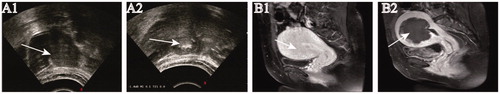 Figure 1. Ultrasonography and MR imaging from a patient with adenomyosis.A1. Pre-HIFU ultrasonography showed the hypoechoic lesion. A2. Real-time ultrasound imaging showed the significant grayscale change in the treated area. B1. Contrast-enhanced MRI obtained before HIFU showed the enhancement of the diffuse adenomyosis. B2. MRI obtained one day after HIFU showed the nonperfused area of the lesion without damage to the surrounding normal tissue.