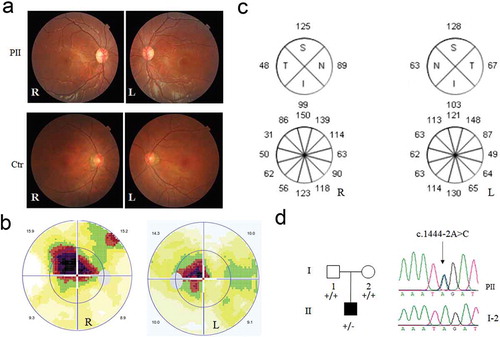 Figure 1. Clinical evaluation and genetic test for the DOA patient. (a) The color fundus image. Color fundus photographs showed paled temporal optic disc in both eyes of the patient, and normal optic disc in both eyes of the normal control. R: right eye, L: left eye. (b)Visual field test in both eyes of the patient. (c)Optical coherence tomography of the right (R) and left (L) eyes around optic disc for patient. (d) The novel heterozygous variant, c.1444–2A>C in the DOA patient, confirmed by Sanger sequencing. PII, DOA patient; I-2, mother, as a family control. “+”, wild-type allele; “-”, mutant allele