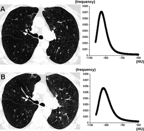Figure 2  A 62-year-old man with chronic obstructive pulmonary disease (GOLD stage 4, FEV1%predicted = 21%). CT images and the density histograms at full inspiration (A) and expiration (B) are demonstrated. The changes in kurtosis and skewness are relatively small, suggesting more homogeneous lung density on the expiratory image (inspiratory scan, kurtosis = 10.6, skewness = 2.4; expiratory scan, kurtosis = 7.5, skewness = 1.9, respectively).