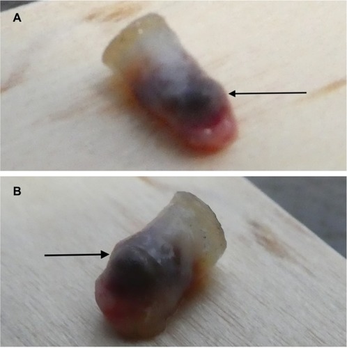 Figure 5 Gross presentation of an organizing thrombus.