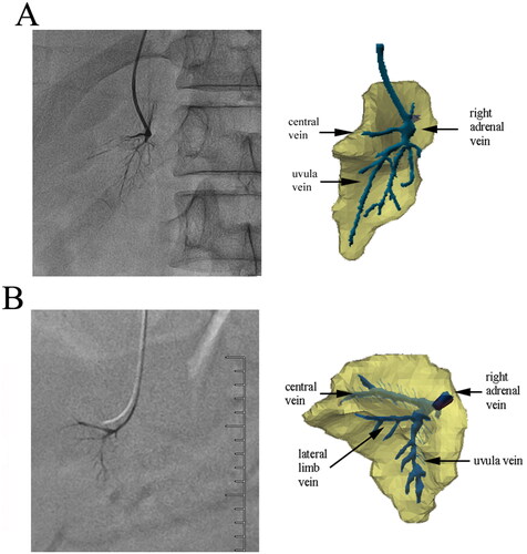 Figure 5. Effect of fusion of the trunk branch type and 3D model. (A) An anteroposterior fusion image of a 37-year-old female patient. The course of the central vein was close to the horizontal direction, and the uvula veins extended downward, with multiple branches distributed in the uvula. (B) Adrenal fusion image at 30 degrees right anterior oblique of a 47-year-old male patient. The angle between the uvula and central veins was close to 90 degrees. The distribution of branches of the uvula veins was similar to leaf texture.