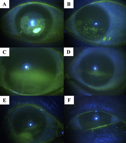 Figure 7 Clinical images showing fluorescein staining: Pre-treatment sham group (A) and post-treatment sham group (B). Sirolimus-loaded liposomes group cases pre-treatment (C and E) and posterior subconjunctival injection of sirolimus liposomal formulation (D and F).
