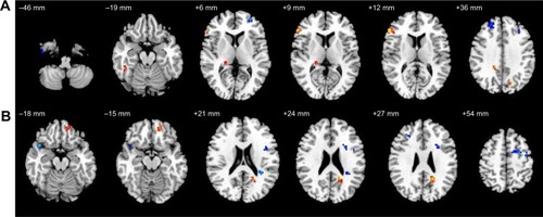 Figure 3 Altered resting-state functional connectivity (rsFC) areas of the cerebellum posterior lobe (CPL) in the sleep deprivation group compared with in the normal sleep group.