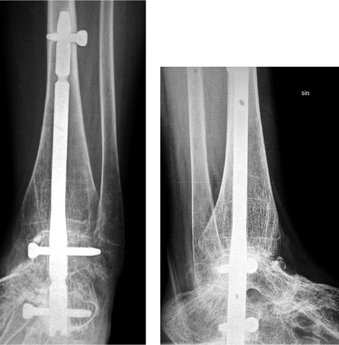 Figure 1. Case no. 18. Radiographically, the ankle was fused at 47 months and the patient was satisfied with the result.A-P (left) and lateral (right) radiographs.