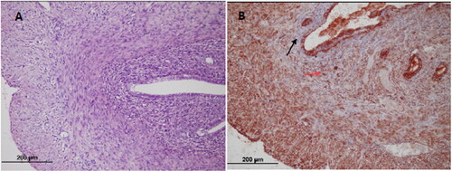 Figure 2. OHSS-placebo group; (A) Endometrium (hematoxylin-eosin × 200) (B) Endometrial stromal cell (black arrow); VEGFR-2 immunostained microvessel (red arrow) (× 200).