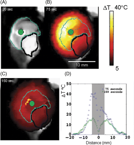 Figure 3. Axial view of the experiment performed using a nanoshell-laden canine liver ex vivo. On a T2-weighted MRI, the cyan line indicates the boundary between tumour phantom and liver parenchyma (dark on image), a bright water pocket (black line) and the laser fibre (green) (A). The maximum extent of heating measure by MRTI is shown on the MRI (B) the maximum temperature was 40°C above background. Diffusion of heat into surrounding healthy tissue is shown in (C) and (D) shows how the heat dissipates within the occlusion.