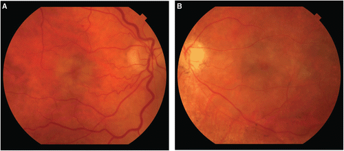 FIGURE 1  Fundus photographs of the right (A) and left (B) maculae demonstrating “cherry red spot” in a patient with PORN on initial presentation.
