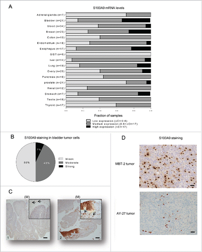 Figure 1. S100A9 is expressed in human tumors. (A) Fraction of samples with low (ΔCt<0.6), medium (0.6<ΔCt<17) or high (ΔCt>17) mRNA expression levels normalized to Hmbs across 17 different human tumor types. (B) Percentage of bladder samples (n = 14) with weak, moderate or strong immunohistochemistry staining for S100A9 in paraffin-embedded tumors (C) Representative images from urinary BCa showing variable S100A9 expression exemplifying (C1) weak (W) or (C2) moderate (M) staining intensities in tumor cells. Original magnification X50, inset X200. Arrow: stromal cells showing strong staining. Scale bars: 100 µm. (D) Representative images showing S100A9 strong staining in stromal cells of MBT-2 and AY-27 tumors. Original magnification X200.